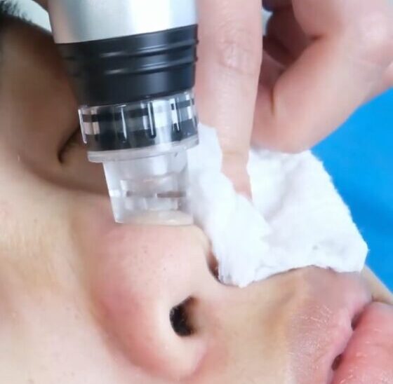 Clear-clogged-pores